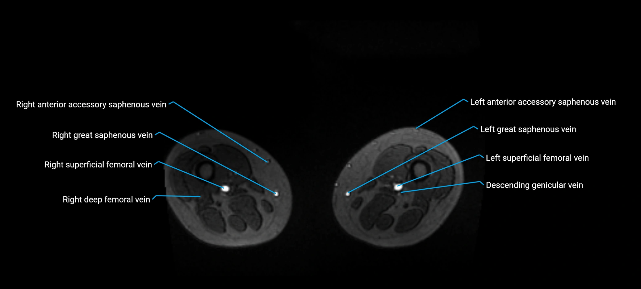 MRV abdomen pelvis & lower limb axial cross sectional anatomy labelled MRI image 309.webp